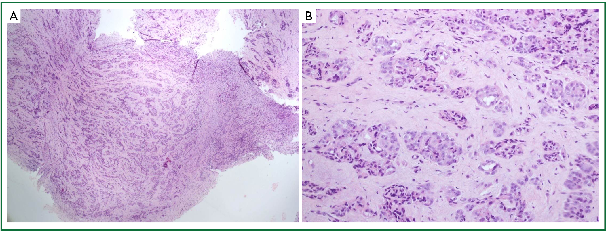Bone metastases with nerve root compression as a late complication in
patient with epithelial
