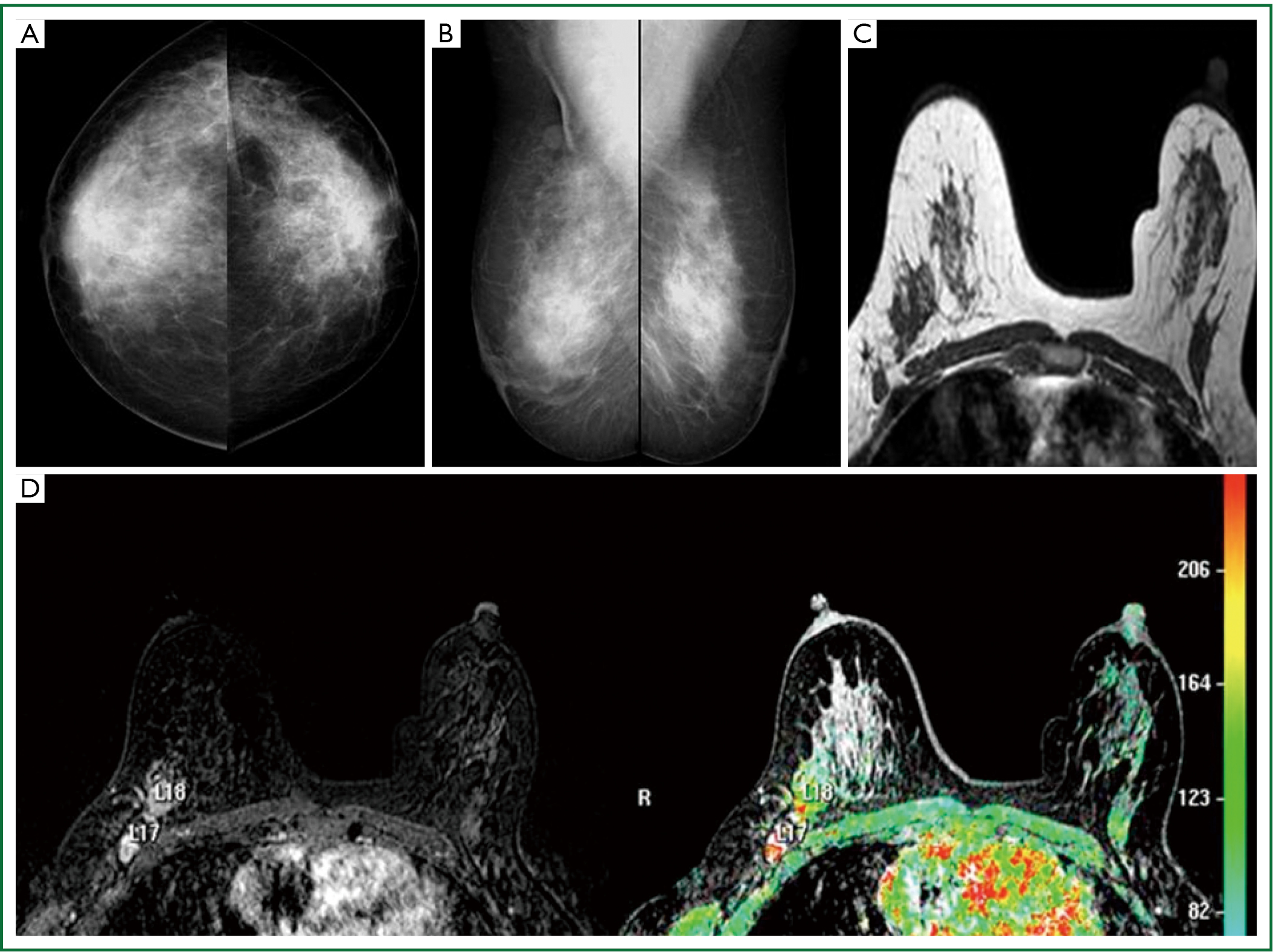 The lactating breast mri findings and literature review