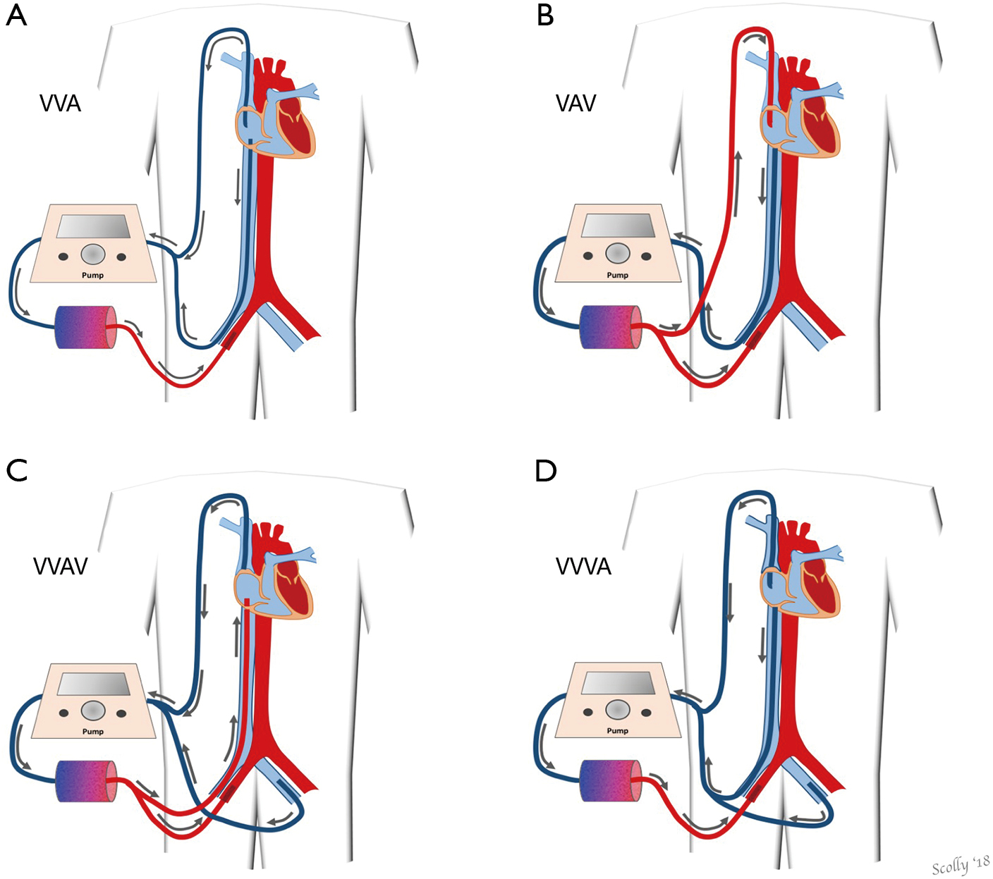 Hybrid extracorporeal membrane oxygenation - Brasseur - Journal of Thoracic Disease