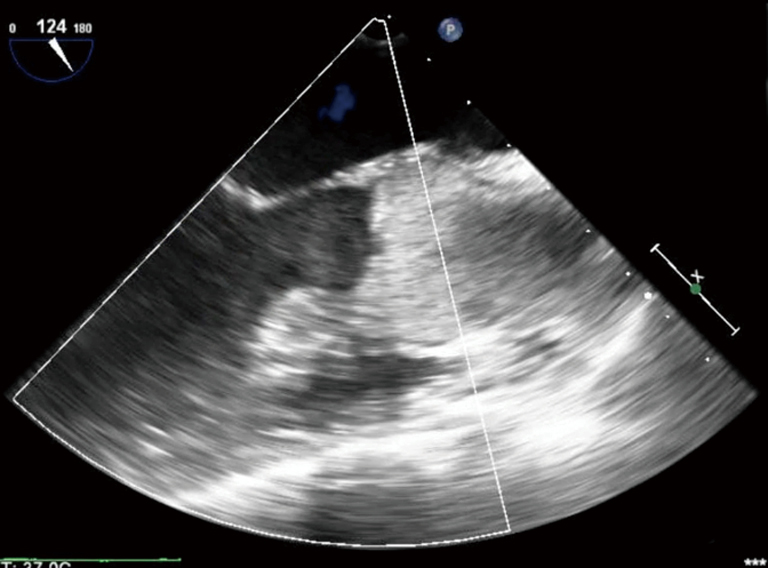Left ventricular distension and venting strategies for patients on venoarterial extracorporeal ...