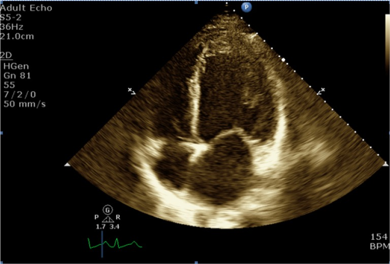 Left ventricular thrombus associated with arteriovenous extra corporeal membrane oxygenation ...