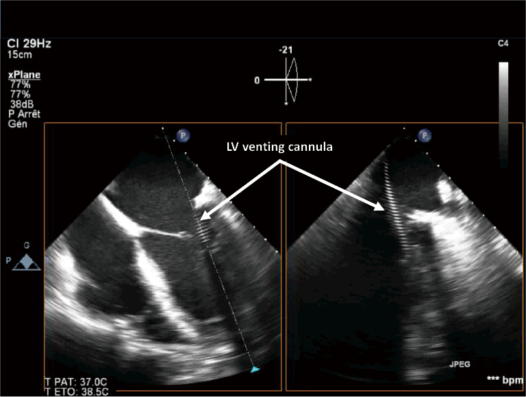 Veno-arterial extracorporeal membrane oxygenation: an overview of different cannulation ...