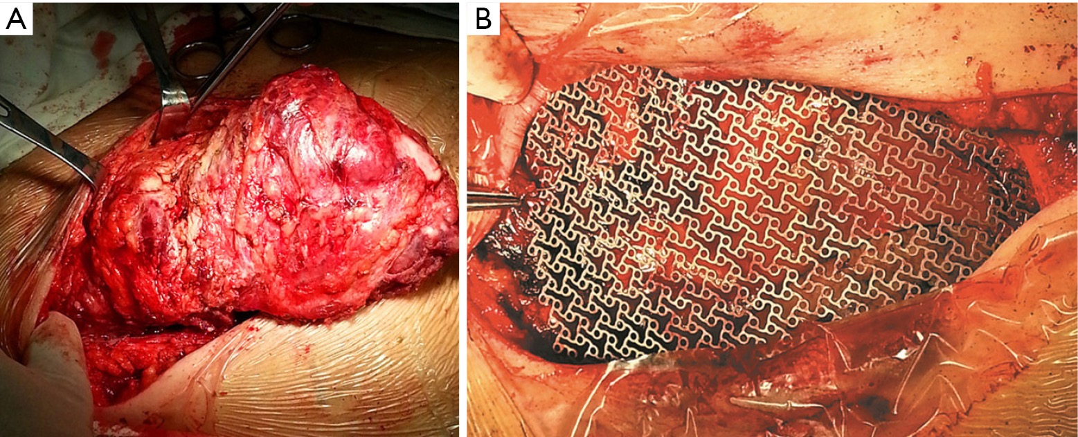 Clinical experience with titanium mesh in reconstruction ...